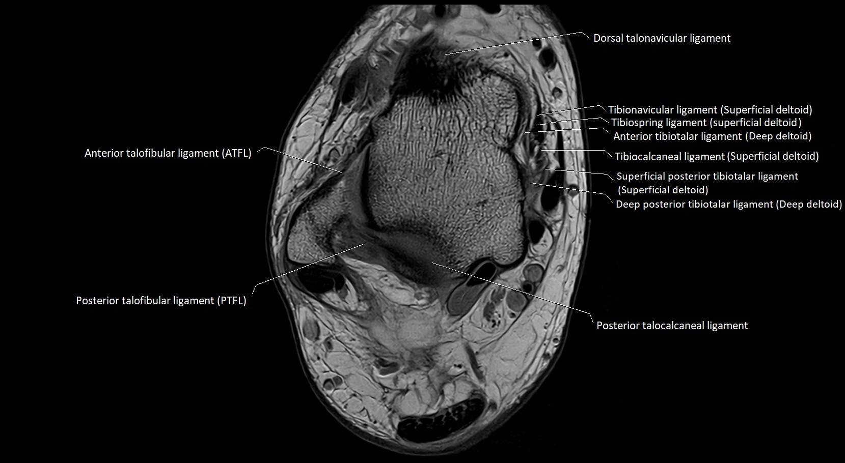 MRI ankle ligaments anatomy axial 3T image 10.webp
